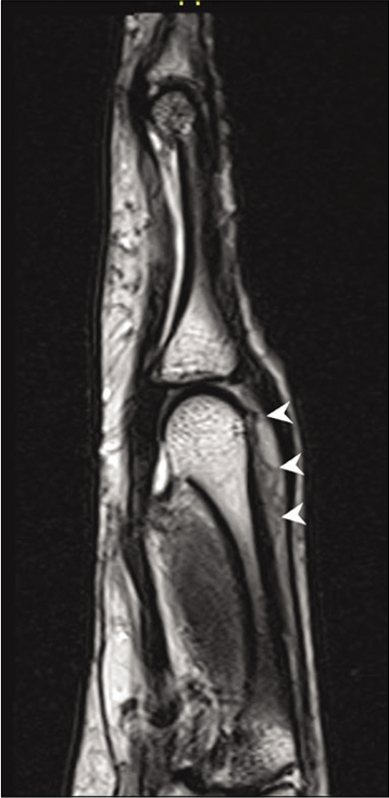 Sag T2 image shows the inflammatory infiltrate as a hyperintense lesion (arrow heads) deep to the extensor digitorum tendon. No involvement of joint space is seen.
