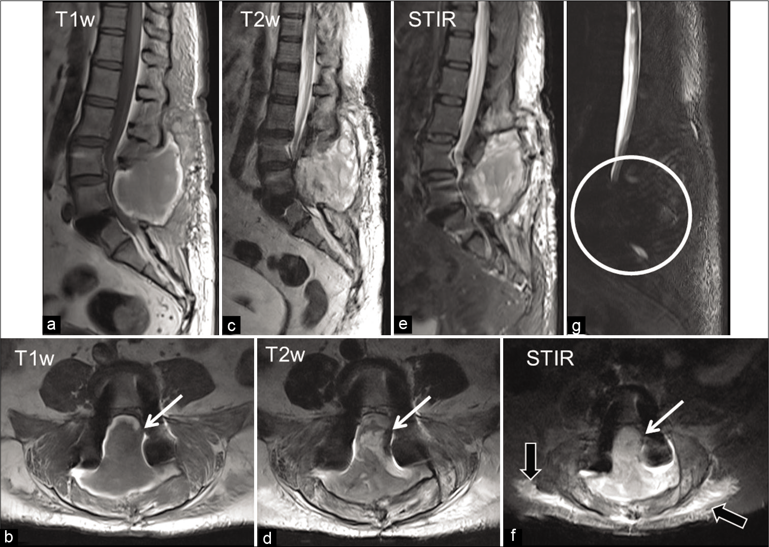 (a-f) Sagittal and axial MR images of the lumbar spine showing: A large paraspinal collection isointense on T1-weighted image (WI) with faint areas of hyperintensity within and peripheral hyperintense rim (a and b), heterogeneously hyperintense on T2WI (c and d), and short-TI inversion recovery (e and f) images. The collection is seen clearly extending into the epidural space (white arrow) causing significant compression of the cauda equina nerve roots and also mass effect over the adjacent paraspinal muscles (black arrows). (g), MR myelography showing complete obliteration of the cerebrospinal fluid space at that level (circle). Bilateral pedicle screws are causing magnetic susceptibility artefacts.