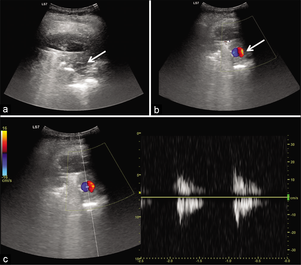 Ultrasonogram of the collection site shows (a) heteroechoic collection with internal echoes and a relatively well defined anechoic lesion (arrow) (b) color Doppler showing a typical “Yin-Yang sign” (white arrow) and arterial waveform (c) suggesting an arterial aneurysm.