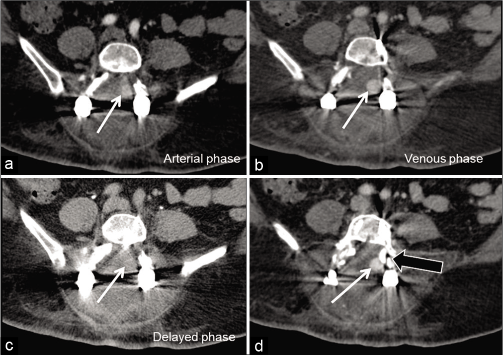 Contrast-enhanced axial computed tomography showing a well-defined round, homogeneously enhancing lesion (white arrows) in the left posterior paramedian epidural space adjacent to the left L4 pedicle screw (black arrow). The lesion showed faint enhancement in arterial phase (a), filling up and more evident in the venous phase (b), and washout on delayed phase (c) suggesting the possible origin of pseudoaneurysm from left branch of L4 lumbar artery.