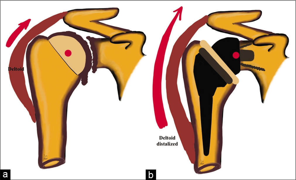 Graphical representation of shoulder biomechanics in (a) severe glenohumeral osteoarthritis demonstrating near-complete loss of joint space, marginal osteophytes at inferior glenoid and humeral head-neck junction, normal deltoid pull, and deficient rotator cuff as seen by superior migration of the humeral head and (b) following reverse total shoulder arthroplasty showing post-operative medialization of the center of rotation of the glenohumeral joint (red dot), distalization of the deltoid attachment increasing lever arm length (red arrow), and recruiting more deltoid fibers to increase shoulder abduction and semi-constrained nature of the prosthesis.