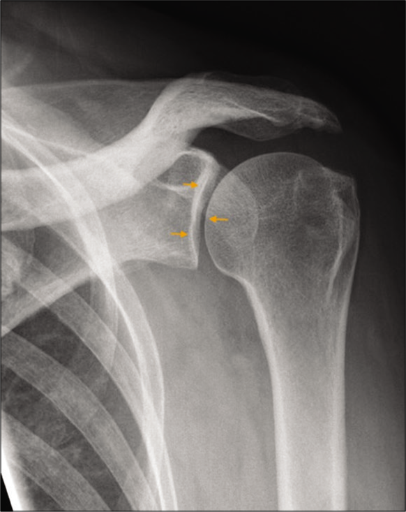 A 43-year-old diabetic male presented with left shoulder pain and restriction of movements. True anteroposterior radiograph (Grashey view) of the left shoulder joint demonstrating a true orientation of the glenohumeral joint space (orange small arrows). Also note preserved acromiohumeral distance and absence of osteophytes or subchondral changes.