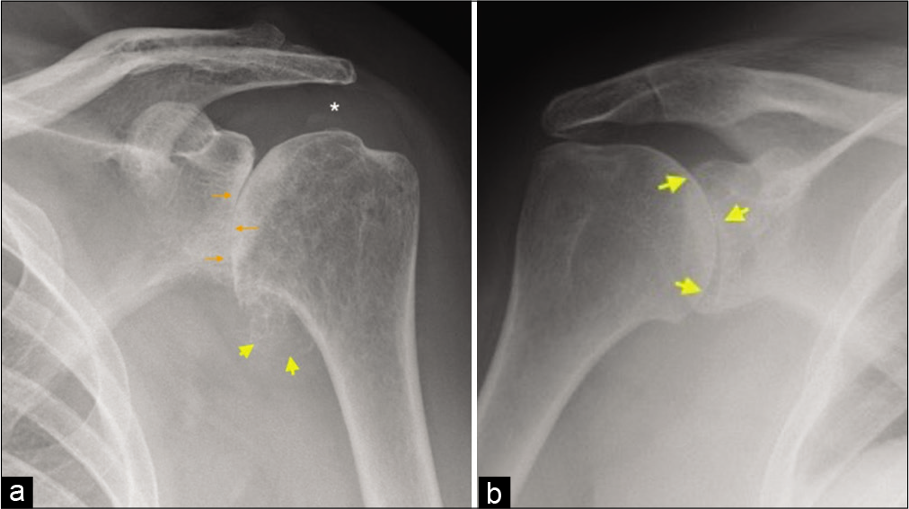 (a) A 67-year-old female presented with the left shoulder pain and movements restriction. True anteroposterior radiograph (Grashey view) demonstrating a complete loss of glenohumeral joint space, subchondral sclerosis and early subchondral cystic changes (orange arrows), sizeable humeral osteophytes in the region of axillary recess (yellow arrow heads), and preserved acromiohumeral distance (asterisk) consistent with findings of severe glenohumeral osteoarthritis of primary degenerative nature and (b) a 44-year-old female presented with multiple joint pain and predominant symptoms in the right shoulder joint. AP radiograph of the right shoulder joint demonstrating symmetrical joint space loss (yellow short arrows) with conspicuous absence of osteophytes and other subchondral changes indicating inflammatory arthropathy. The patient had rheumatoid factor and anti-CCP antibody-positive rheumatoid arthritis.