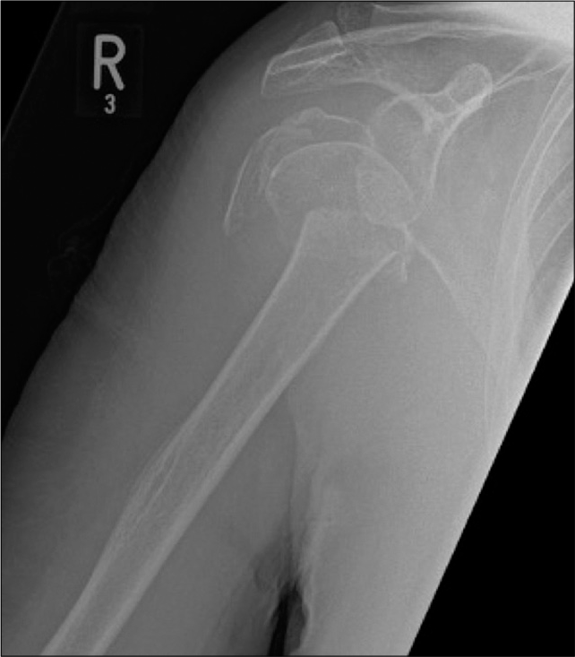 An 81-year-old male with a history of fall down stairs. AP radiograph of the right shoulder joint demonstrates complex multifragmentary proximal humeral fracture. Also appreciate severe osteopenic nature of visualized bones.