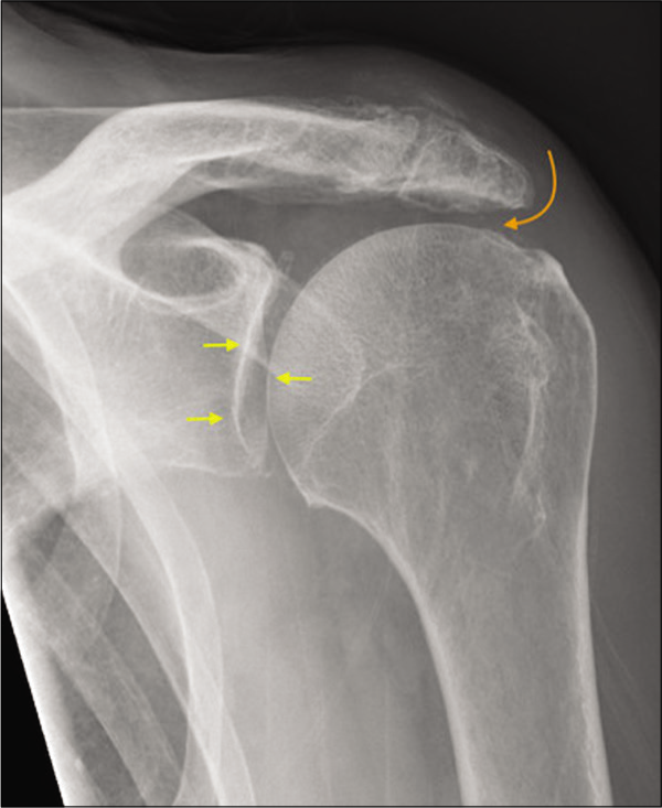 A 55-year-old manual worker presented with shoulder pain predominantly following overhead activities. Grashey view of the left shoulder joint depicting normal glenohumeral joint space (yellow short arrows) and marked narrowing of the acromiohumeral distance (curved orange arrow), degenerate acromioclavicular joint, and absence of osteophytes consistent with early rotator cuff arthropathy. The patient had a history of secondary subacromial impingement and partial-thickness cuff tear which has progressed to medially retracted full-thickness rotator cuff tear.