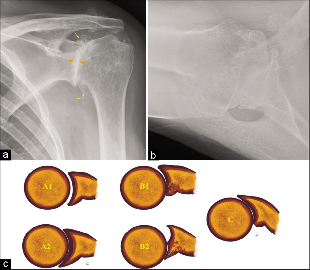 An 80-year-old male presented with long-standing history of the left shoulder pain and movement restriction. (a) Grashey view of the left shoulder joint showing bone-on-bone appearance with complete loss of joint space and subchondral changes (orange arrowheads) and circumferential marginal osteophytes involving glenoid (straight yellow arrow) and humeral head (curved yellow arrow) and (b) axillary view demonstrating glenoid remodeling and change in the glenoid morphology besides confirming severe osteoarthritis. (c) Graphical representation of the Walch classification extensively used by shoulder surgeons preoperatively to select surgical procedure and glenoid prosthesis. A1 (early) and A2 (established) concentric glenoid cartilage loss, most commonly seen following inflammatory arthropathy whereas B1 (early) and B2 (advanced) eccentric, posterior predominant glenoid cartilage loss with remodeling of the articulating glenoid is predominantly seen in primary degenerative osteoarthritis. Glenoid retroversion of more than 25° with posterior humeral head subluxation (c) requires additional bone graft or modified baseplate to augment posterior glenoid. This classification has further extended describing anterior glenoid remodeling and advanced posterior cartilage loss.