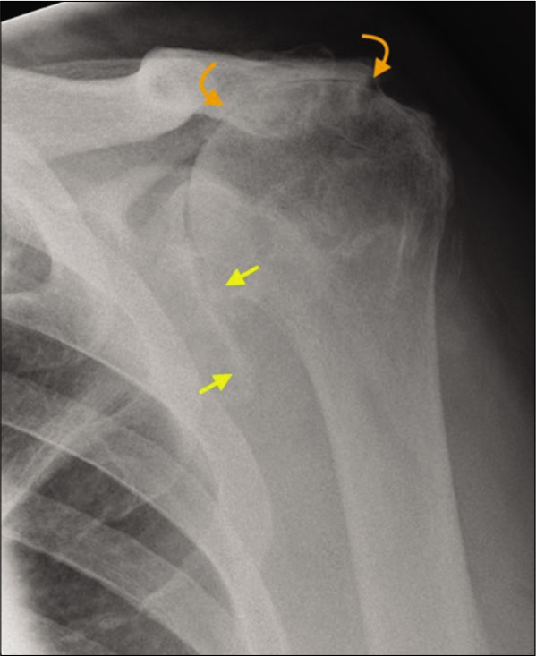 A 72-year-old male presented with long-standing history of rotator cuff tear and severe loss of the left shoulder function. There is complete loss of acromiohumeral distance due to superior migration of the humeral head (yellow arrows) resulting in bony remodeling of the undersurface of the acromion process termed as “acetabularization” of the acromion (curved orange arrows). These appearances are characteristic of longstanding failed rotator cuff and secondary advanced rotator cuff arthropathy.