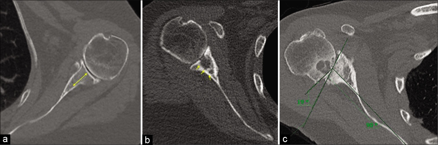(a) A 66-year-old female with left shoulder osteoarthritis. True axial image of the CT scan (bone kernel) depicting adequate glenoid bone stock. The glenoid bone stock is measured at the center of the glenoid in a reformatted true axial image from articulating surface of the glenoid to the scapular neck and should be devoid of large intraosseous cystic changes. Good glenoid bone stock is necessary for adequate glenoid component and screw purchase to reduce chances of prosthesis loosening. (b) A 73-year-old female with severe right shoulder osteoarthritis. Axial CT scan image in a bony kernel showing large intraosseous cystic changes resulting in poor glenoid bone stock. (c) A 69-year-old female with right shoulder osteoarthritis. Reformatted true axial image of the right shoulder joint in a bony kernel showing a Friedman’s technique of the glenoid version measurement. Friedman’s line is measured from the medial tip of the scapular up to the midpoint of the articulating glenoid and another line is drawn perpendicular to it. It is also known as scapular axis. Another line connecting the anterior and posterior margin of the glenoid is drawn. The angle between the scapular axis and the plane of the glenoid is taken as angle of retroversion (in our case 19°). Also appreciate for humeral head bone stock which is surgically less relevant for planning reverse total shoulder arthroplasty except in cases where humeral head graft is needed to augment the glenoid bone stock (e.g., BIO RSA – Bony Increased Offset Reversed Shoulder Arthroplasty).