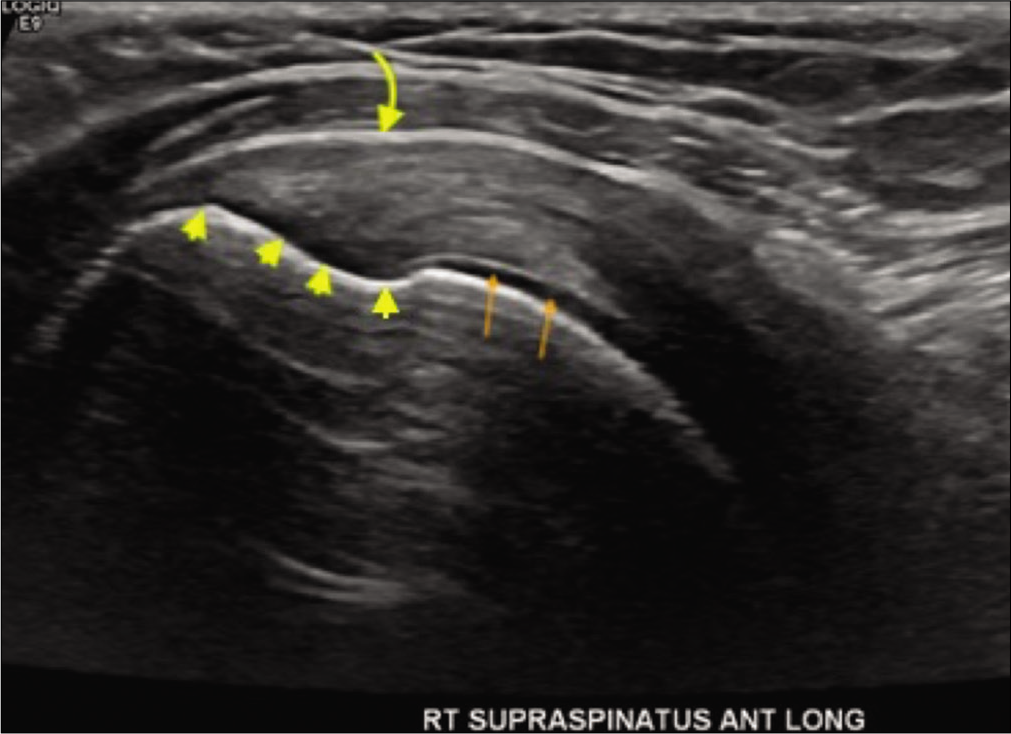 A 34-year-old female presented with the right shoulder pain while raising arm overhead. Grayscale ultrasound image through the long axis of the supraspinatus enthesis depicting supraspinatus footprint (yellow arrowheads) with underlying normal subchondral bone, adjacent pristine humeral head cartilage (orange arrows), and normal appearances of subacromialsubdeltoid bursa (curved yellow arrow).