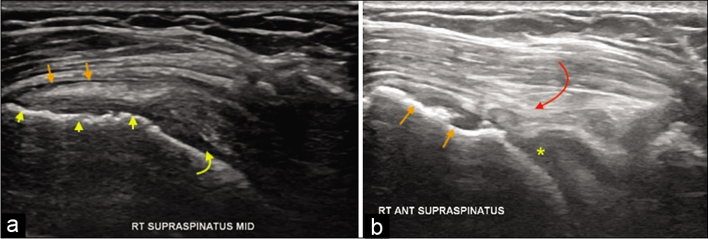 A 55-year-old female with the right shoulder pain and impingement symptoms. (a) Grayscale ultrasound demonstrating partial-thickness tear of the distal supraspinatus with cortical irregularity at its enthesis (yellow arrowheads), irregularity of the humeral head cartilage (yellow curved arrow), and subacromial subdeltoid bursitis (orange short arrows). Changes in humeral head cartilage may indicate heralding rotator cuff arthropathy. Follow-up ultrasound after 6 years. (b) In the same, patient showing full-thickness tear with remarkably thin distal tendon (curved red arrow), osteophytes at the supraspinatus enthesis (orange short arrows, and completely degenerated humeral head cartilage replaced by joint effusion (yellow asterisk). The patient has had severe fatty atrophy of the supraspinatus (shown below in MRI) and advanced rotator cuff arthropathy on the radiograph.