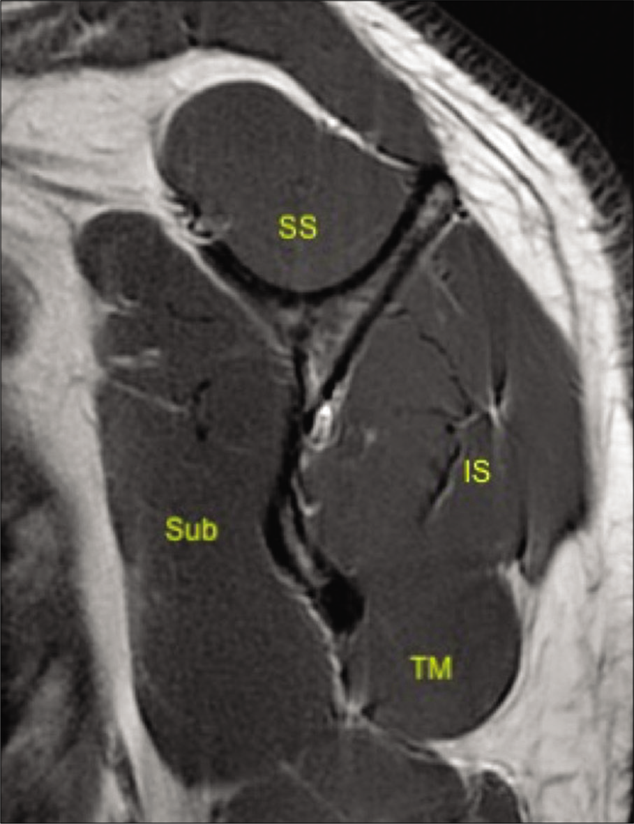 A 33-year-old male volunteer without any shoulder symptoms. T1-weighted sagittal image at the level of the scapular neck demonstrating normal appearances of rotator cuff comprising of subscapularis (Sub), supraspinatus (SS), infraspinatus (IS), and teres minor (TM) and their myotendinous junctions.