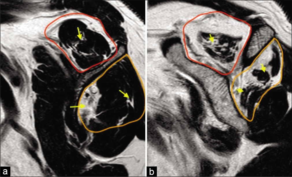 A 55-year-old female with right shoulder pain and impingement symptoms. (a) T1-weighted sagittal image at the level of scapular neck demonstrating reduced muscle bulk of the supraspinatus (red selection) and the infraspinatus (orange selection), their fatty replacement and fatty infiltration along their myotendinous junctions (yellow arrows) consistent with Grade 1 (early) fatty atrophy and (b) severely reduced muscle bulk (more than 50%), fatty replacement and infiltration along the myotendinous junctions consistent with Grade 3 (advanced) fatty atrophy of the rotator cuff. Shoulder surgeons prefer semi-quantitative Goutallier classification which has prognostic significance.