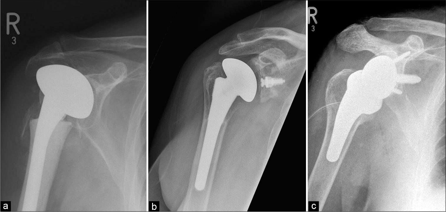 Different types of shoulder arthroplasties: (a) Hemiarthroplasty – only humeral head is replaced with prosthesis. Please appreciate retention of the native glenoid, (b) total shoulder arthroplasty with non-cemented humeral component and a radiolucent glenoid baseplate with a central peg. It is also known as “anatomical total shoulder replacement” and preferred for patients with functional rotator cuff and (c) reverse total shoulder arthroplasty for cuff-deficient shoulders showing reversed/ inverse relationship of the convex glenosphere and a concave humeral articulating surface at the top of a short-stemmed prosthesis (also seen is a surgical drain).