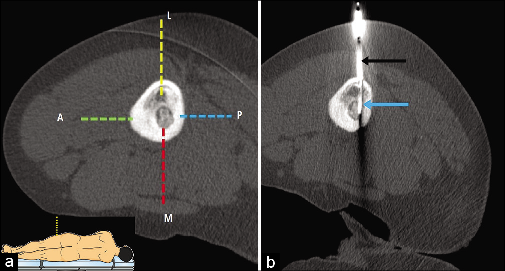 (a and b) CT-guided RF ablation in a 12-year-old male with osteoid osteoma in medial cortex of the left femoral diaphysis (lateral decubitus position). (a) Four possible needle trajectory approaches can be defined for the lesion. Anterior (dotted green line), medial (dotted red line), and posterior (dotted blue line) approaches were not adopted due to risk of needle slippage, less operating space, and risk of injury to neurovascular bundle respectively. Lateral approach (dotted yellow line) was selected due to technical feasibility and the lower risk of complications. The schematic diagram of lateral decubitus position has been demonstrated in inset. (b) The insulated needle (black arrow) was introduced with subsequent insertion of RF probe up to the nidus (blue arrow).
