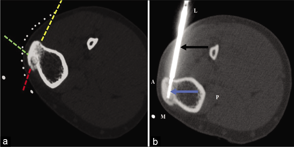 (a and b) CT-guided RF ablation of osteoid osteoma of the left tibia in a 26-year-old male. (a) The nidus is located in the anteromedial aspect of tibial tuberosity. Three possible needle trajectory approaches can be defined (dotted red, yellow, and green lines) for this lesion. The standard technique involves approaching this lesion from the medial (dotted red line) or anterior tibial cortex (dotted green line), which is not appropriate for this patient. Instead, approaching the lesion from the lateral unaffected opposite tibial cortex (dotted yellow arrow) was preferred. (b) An insulated needle (black arrow) was introduced with subsequent insertion of RF probe (blue arrow) up to the nidus.