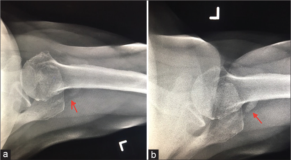 Case Report Archives - Indian Journal of Musculoskeletal Radiology