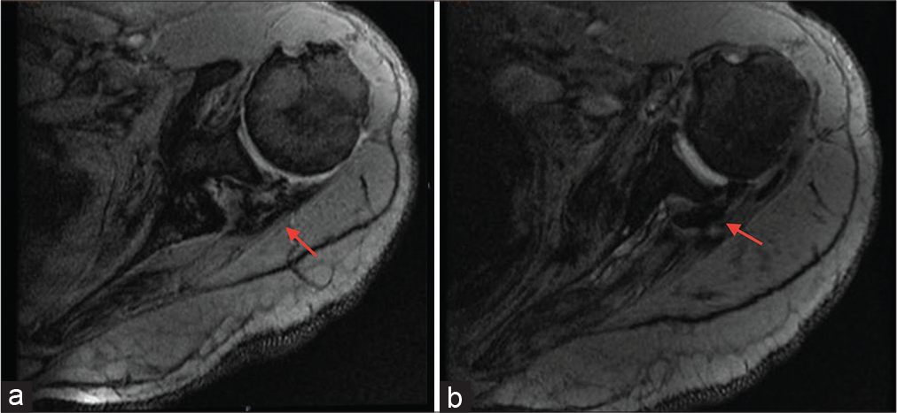 Axial Medic images show hypointense signal in teres minor tendon and musculotendinous junction suggestive of mineralization (red arrows). Findings are consistent with diagnosis of calcific tendinopathy of teres minor.
