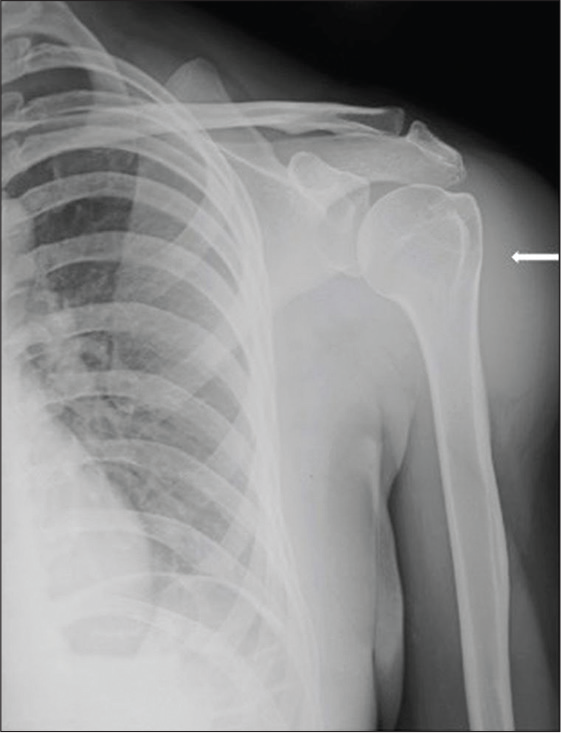 Radiograph showed soft-tissue opacity in the left shoulder region, lateral to the joint (arrow). No erosions were seen. No widening or narrowing of joint space was seen.