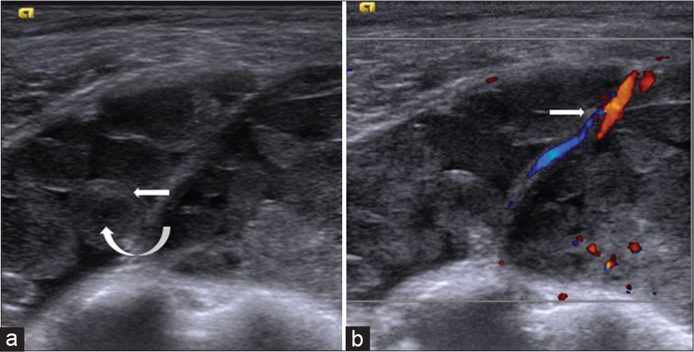 (a) Ultrasonography showed fluid in the subacromial subdeltoid bursa with septations and multiple intrabursal round isoechoic loose bodies (curved arrow) with echogenic rims (arrow); (b) on colour Doppler, the septa showed vascularity (arrow).