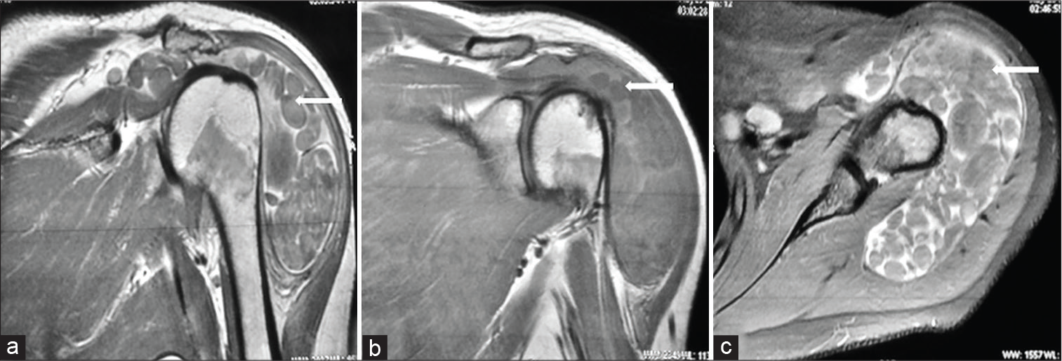 (a) Coronal T2-weighted, (b) coronal T1– weighted, and (c) axial gradient-echo magnetic resonance imaging images show subacromial subdeltoid bursitis with multiple isointense round intrabursal loose bodies without any blooming (arrows).