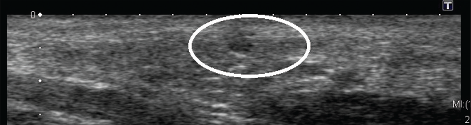 A well-defined hypoechoic ovoid lesion is seen in deep dermis and subcutaneous fat of the left hypothenar eminence on gray scale ultrasonography.