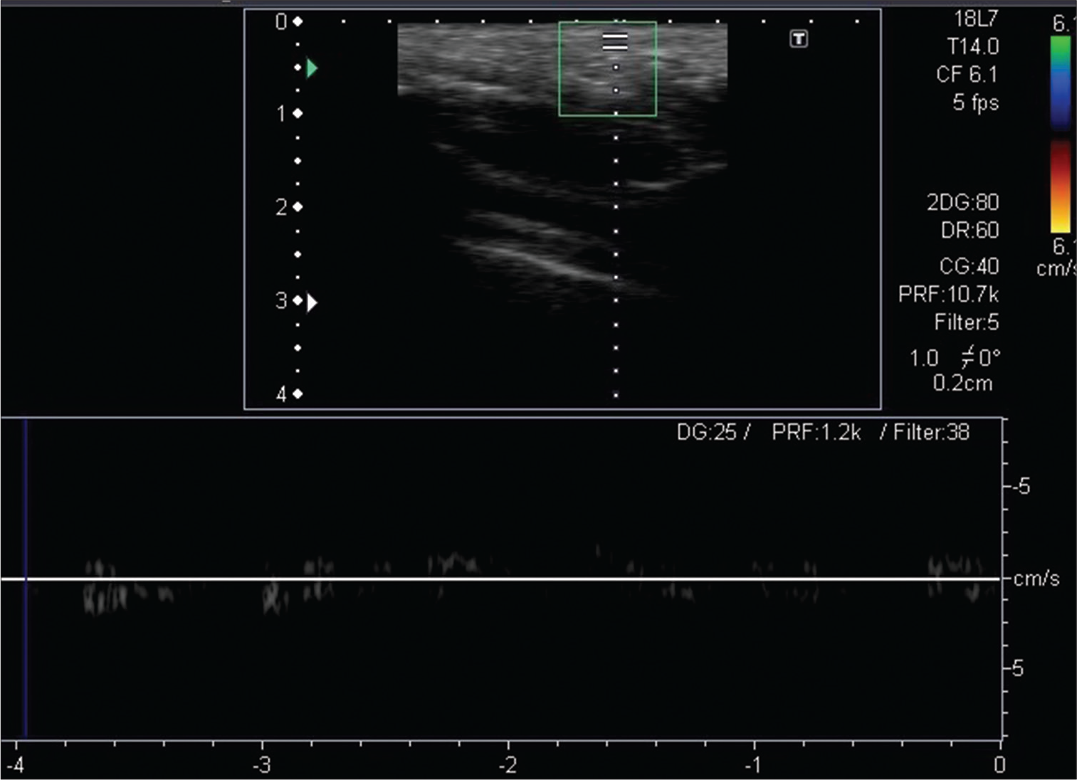 Low velocity arterial and venous signals are noted in the lesion on the spectral Doppler study.