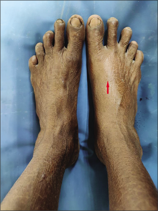 At presentation: Right foot showing tense and shiny skin over extensor hallucis longus tendon with swelling of overlying area (arrow).