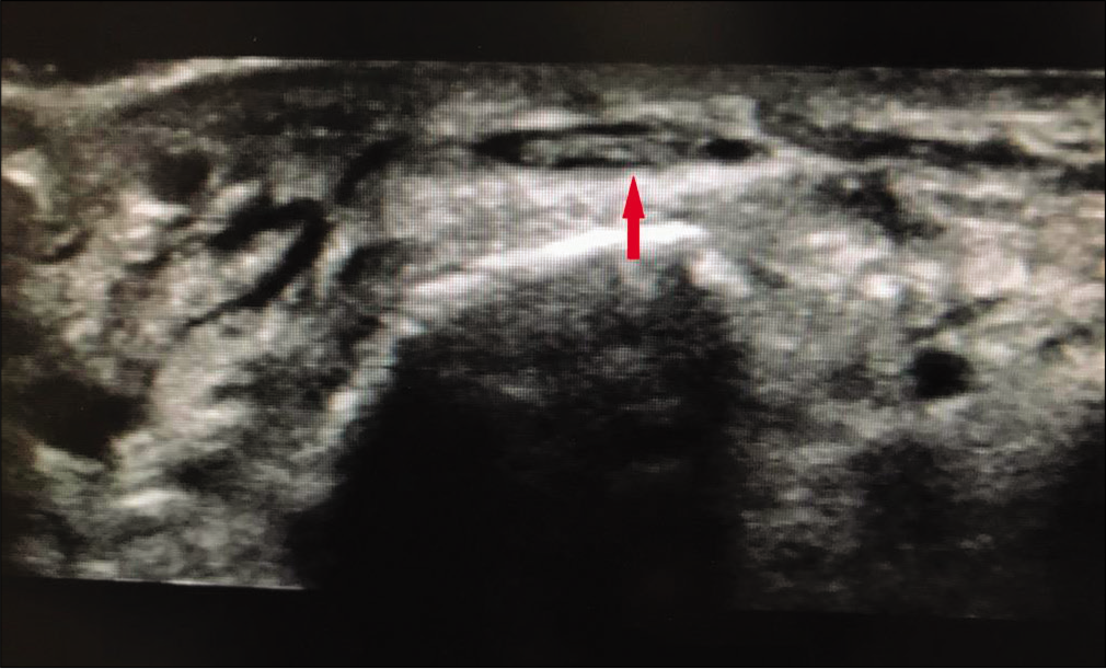 Ultrasonography image taken in short-axis showing obvious anechoic area surrounding extensor hallucis longus tendon (arrow) suggestive of inflammation.