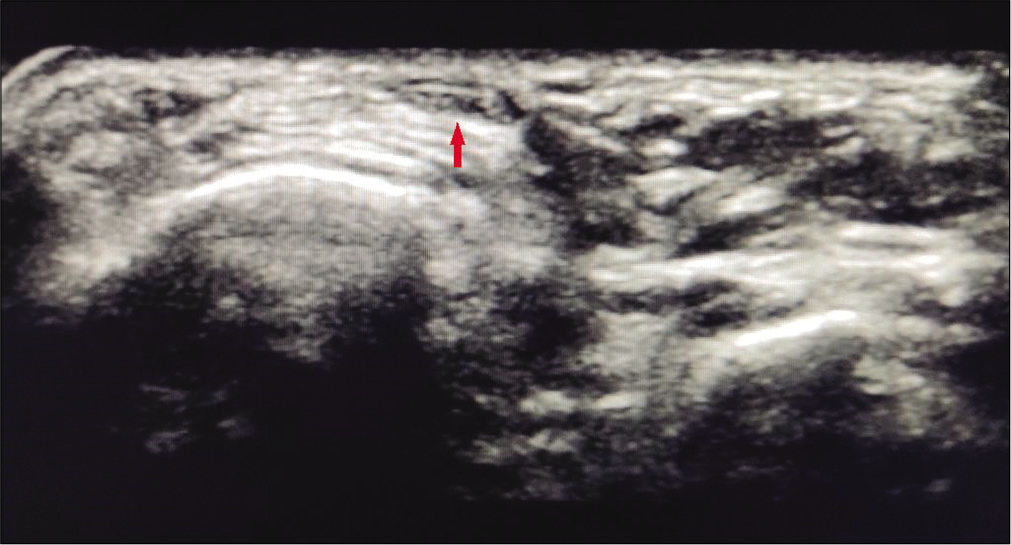 Ultrasonography image of opposite foot showing a healthy extensor hallucis longus tendon with normal echotexture and echogenicity (arrow).