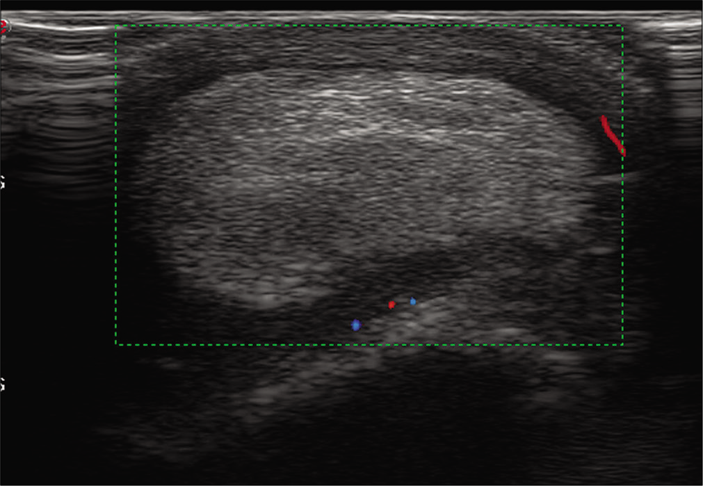 Ultrasonography image reveals a well-defined echogenic mass lesion located within the olecranon bursa. There was minimal vascularity within the wall of the bursa and no vascularity within the mass itself.