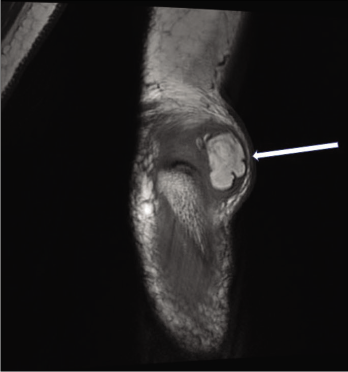 T1-weighted coronal MR image reveals a well-defined uniformly hyperintense mass (arrow) lesion within the olecranon bursa.