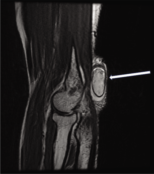 T2-weighted sagittal MR image reveals a well-defined hyperintense mass lesion with a uniform hypointense capsule (arrow) within the olecranon bursa.