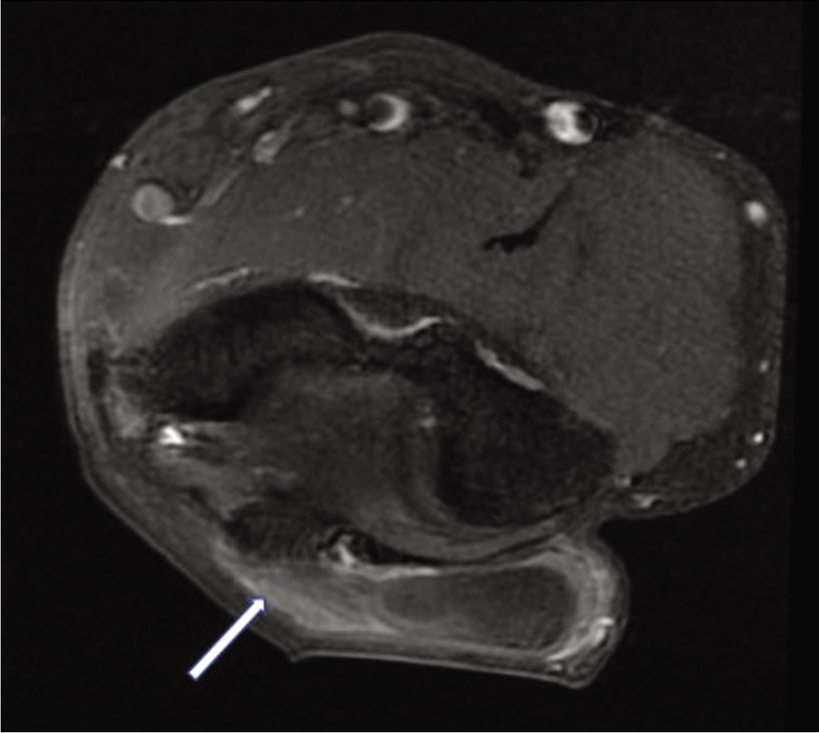 Fat-suppressed contrast-enhanced axial T1-weighted image reveals a well-defined, non-enhancing mass lesion within the olecranon bursa. It is seen to be attached to the wall of the bursa, by means of a poorly enhancing stalk (arrow).
