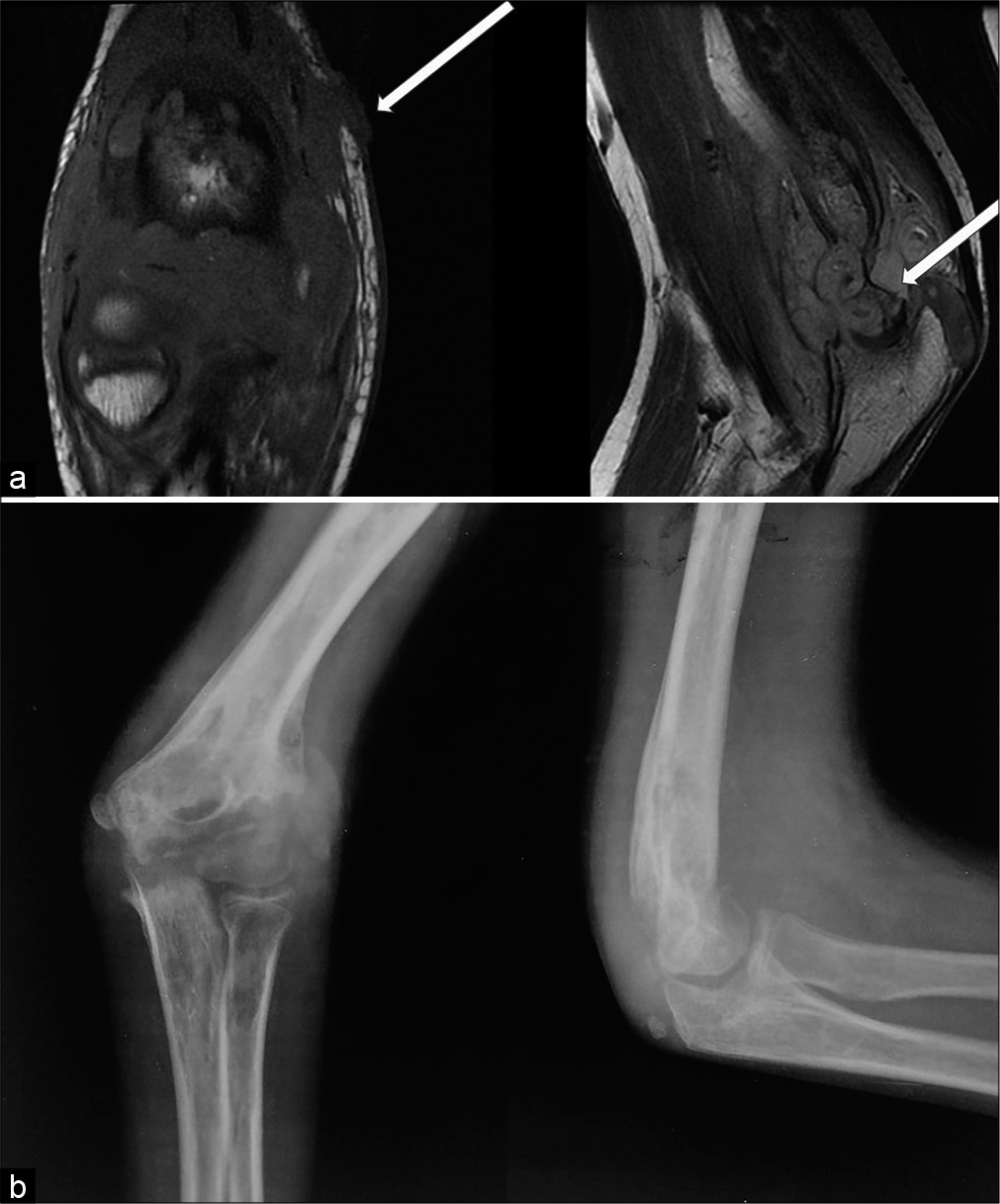 (a) Non-contrast T1-weighted coronal and T2-weighted sagittal MR images of a 13-year-old male child who complained of swelling and pain over Rt elbow of 6 months duration reveals Grade 3 synovial thickening, Grade 3 erosion involving the trochlea (thick arrow), and an ulcer over the medial epicondyle (thin arrow). (b) Radiograph anteroposterior and lateral view of the Rt elbow revealed large erosions, periarticular osteopenia, soft-tissue edema.