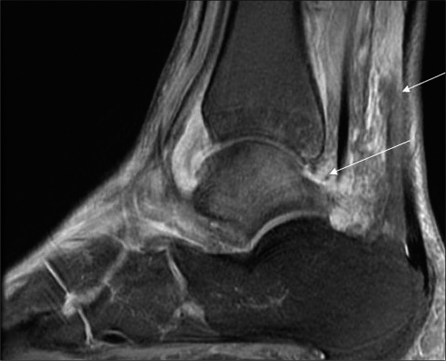 Sagittal fat-suppressed T2-weighted magnetic resonance imaging image of the ankle of a 17-year-old female shows Grade 2 joint effusion and Grade 2 perisynovial edema (arrow).