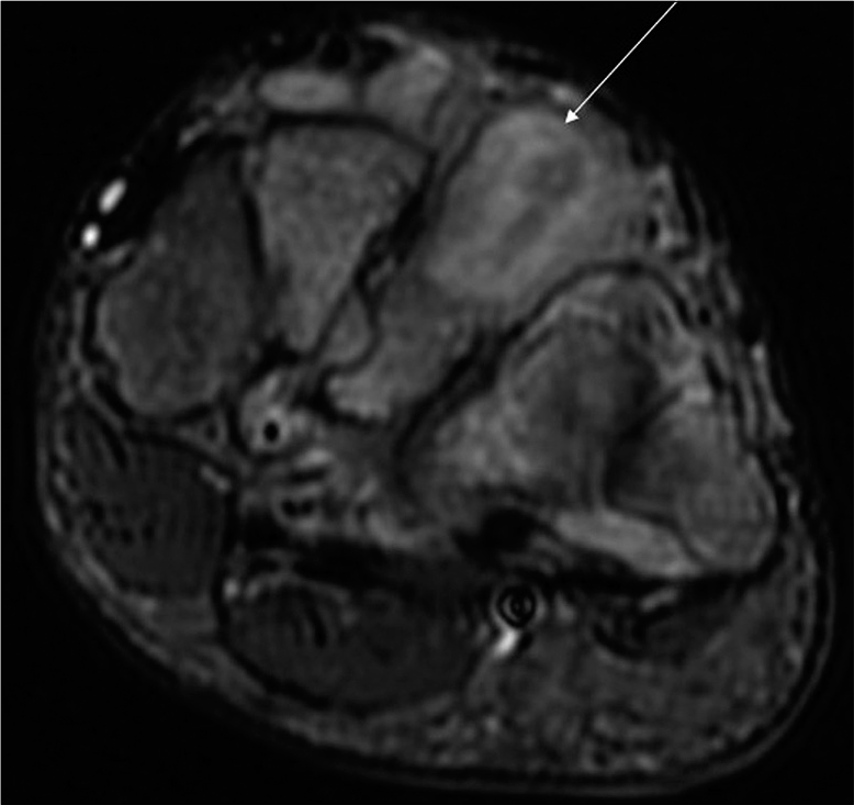 Axial T2-weighted fat-suppressed image of a 45-year-old male patient with a histopathologically proven case of the midfoot tubercular involvement shows evidence of osteomyelitis involving the third metatarsal (arrow).
