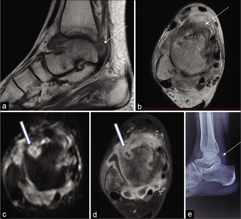 Sagittal T1-weighted (a) and axial T2-weighted (b) MR images of the ankle joint of a 17-year-old female reveal uniform Grade 1 synovial thickening that is hyperintense on T1-weighted images (thin arrow) and hypointense on T2-weighted images (thick arrow). Axial diffusion-weighted image (c) and axial contrast-enhanced images (d) reveal erosions with enhancing rim and restriction on diffusion-weighted image (thick arrow). Radiograph lateral view (e) reveals thickened synovium (thin arrow).