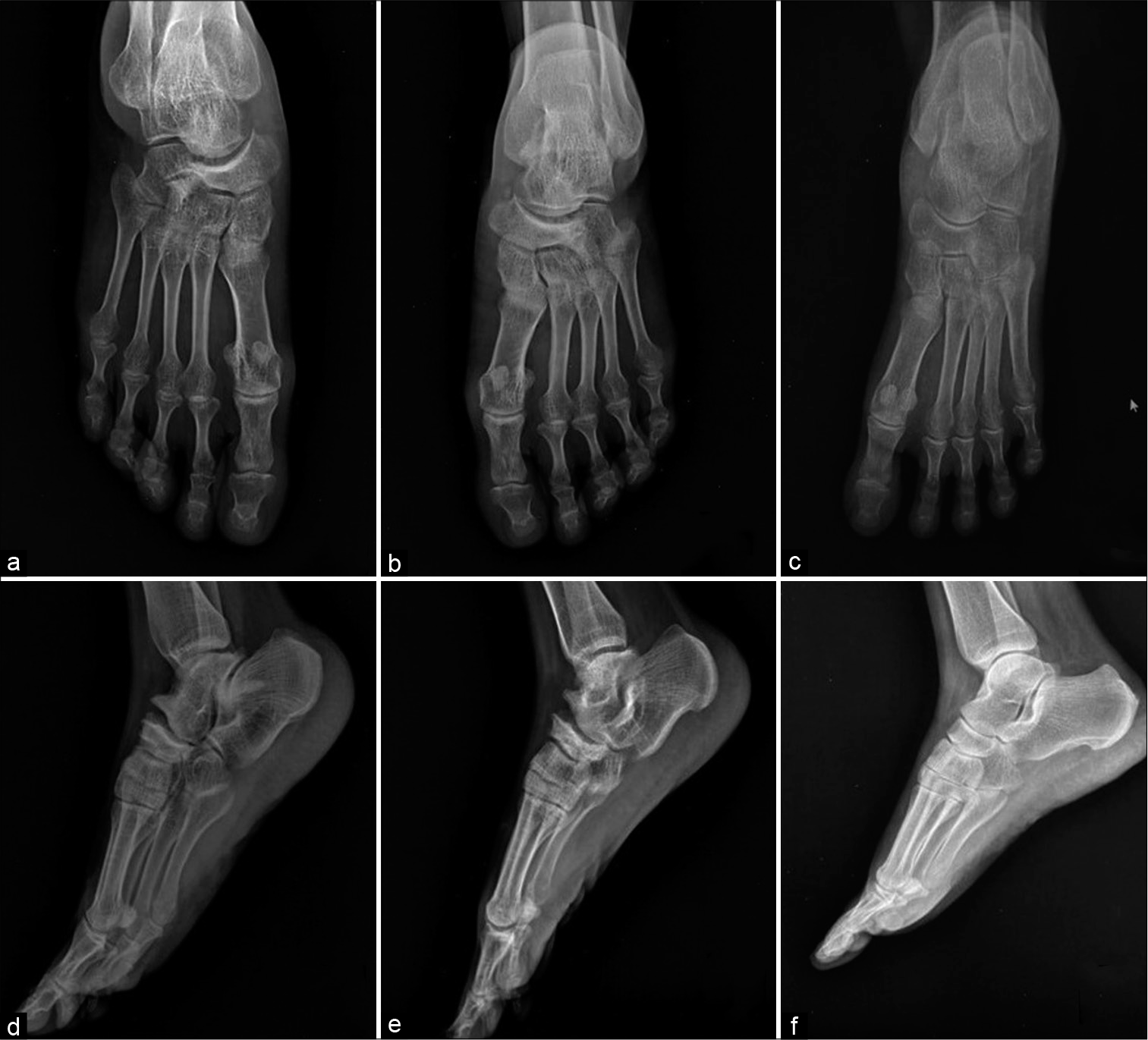 Anteroposterior Radiograph of the right foot (a) and left foot (b) showed-(1) Collapse of the lateral portion of navicular bone with resultant comma-shaped deformity. (2) Loss of cyma line (‘S’ shaped line along the talonavicular and calcaneocuboid articular surface which indicates normal alignment. (3) Peri-talar (i.e., medial) subluxation of the remaining navicular fragment with respect to the head of the talus. (4) Subchondral sclerosis of the articular surface of the tarsal navicular. Lateral radiograph of the right foot (d) and left foot (e) showed- (1) Reduction in the navicular height in AP dimension (2) Subchondral sclerosis of the talo-navicular articular surface of navicular bone (3) Asymmetry of the talonavicular joint space with apparent widening of the dorsal aspect (4) Anterior marginal osteophytes at the talonavicular joint. Anteroposterior (c) and lateral (f) radiographs of normal foot is provided for comparison.