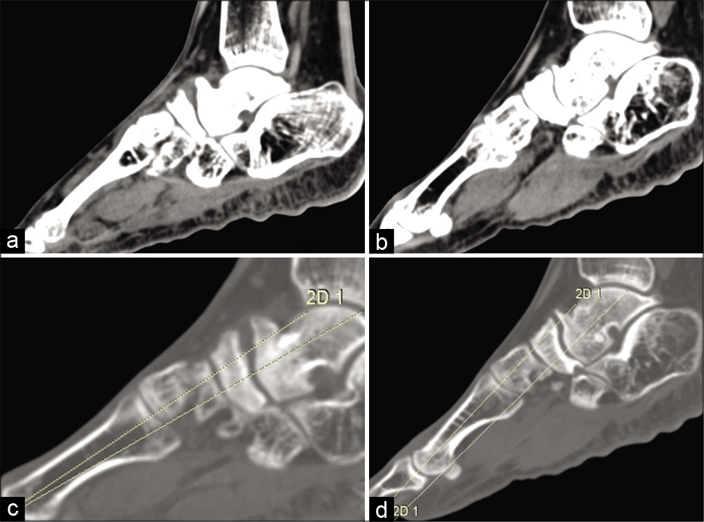 Sagittal unenhanced computed tomography images of the ankle with foot [Right (a) and left (b)] showed findings similar findings as radiography, including bilateral reduction in size of the tarsal navicular with asymmetric reduction of the talonavicular joint space and anterior marginal osteophytes. The angle between the long axis of the first metatarsal and talus (Meary Tomeno angle) was calculated and measured on unenhanced computed tomographic images of bilateral feet in sagittal view (bone window). It measured 4 degrees on the right (c) and 2 degrees on the left (d).