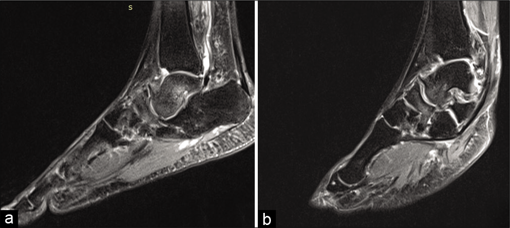 Right (a) and Left (b) Sagittal short tau inversion recovery sequence Magnetic resonance images showed diffuse high signal intensity within the body of Navicular and head and neck of the talus suggestive of marrow edema which can be attributed to secondary talonavicular osteoarthritis.