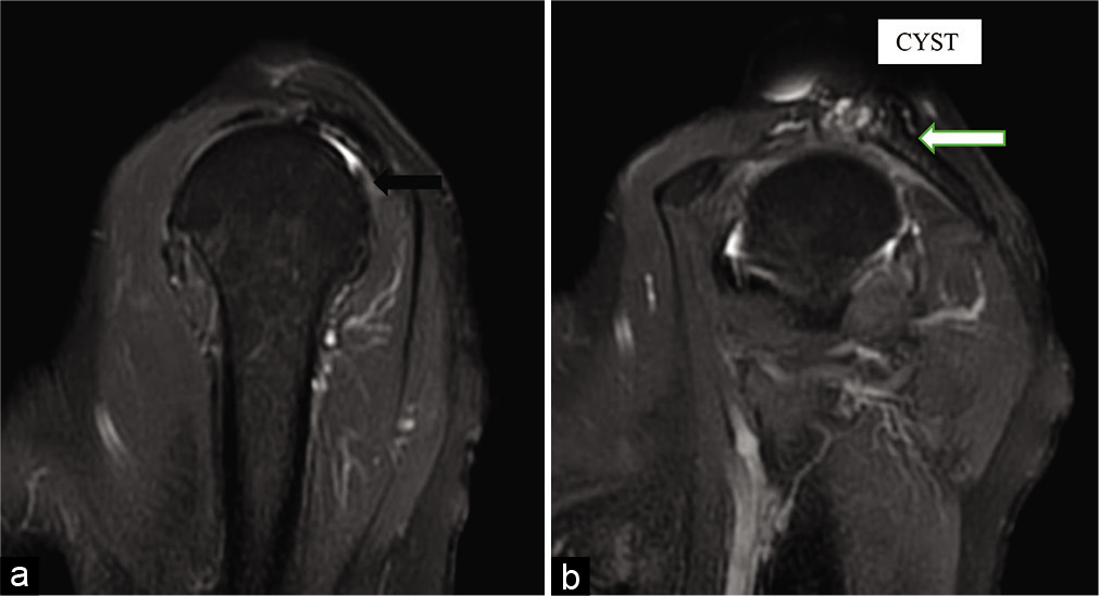 Sagittal PD FATSAT images (a and b) reveal near-complete tear of the supraspinatus and conjoint tendons (black arrow). Chronic arthropathy (white arrow) and large lobulated cystic lesion overlying the acromioclavicular joint.
