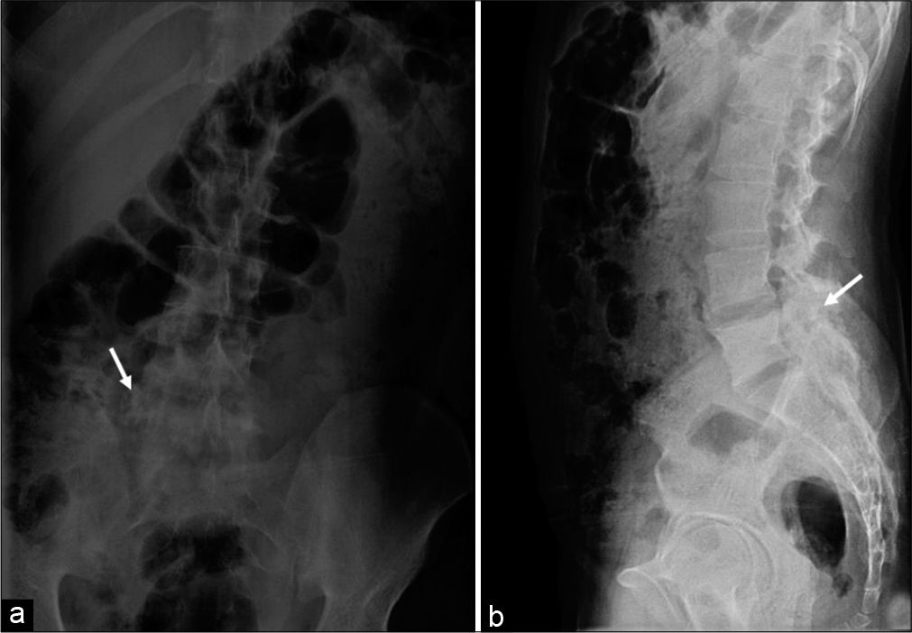 A 23-year-old male who presented with low backache, stiffness, and intermittent fever for past 1 year. Findings: Anteroposterior (a) and lateral (b) radiographs reveal heterogeneous expansile sclerotic lesion (arrow) in the right pedicle of L5 vertebra also involving the transverse process associated with the right facetal arthropathy.