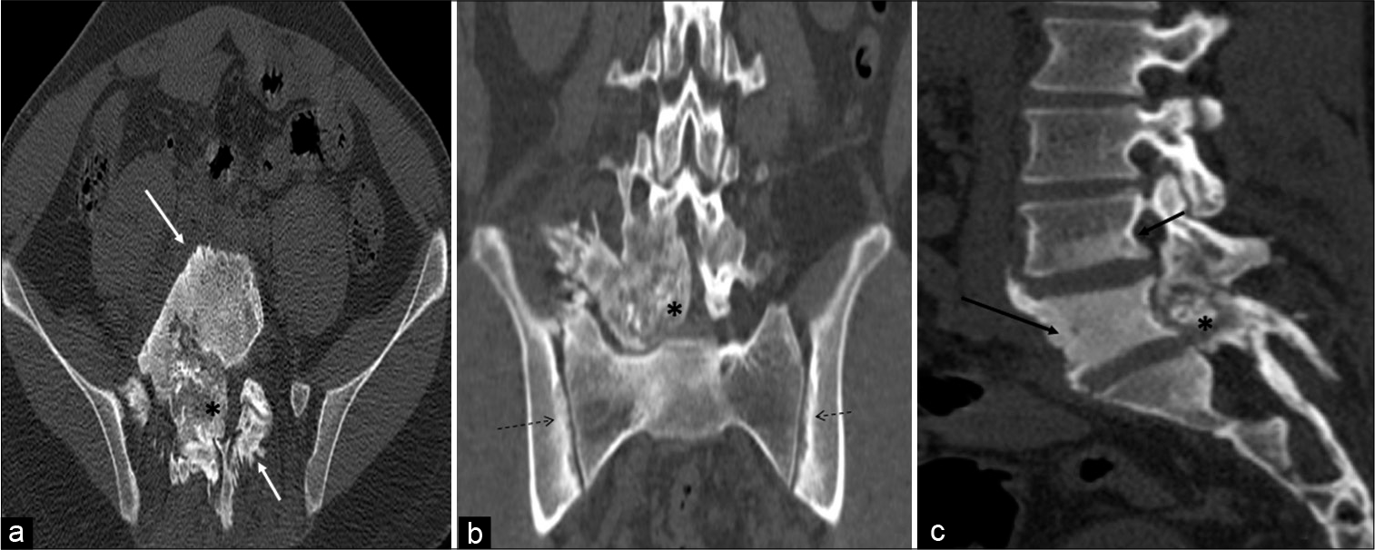 A 23-year-old male who was diagnosed with osteoblastoma showing toxic flare and coexistent HLA-B27-related ankylosing spondylitis. Axial (a), coronal (b), and sagittal (c) computed tomography multiplanar reformations showing heterogeneous expansile predominantly blastic/sclerotic lesion (asterisk) with internal speckled mineralization centered at the junction of right pedicle and transverse process of L5 vertebra. There is extensive periostitis/periosteal reaction (white arrow) mimicking an aggressive neoplasm. Sclerosis is seen in the entire L5 and inferior aspect of the L4 vertebra (black arrow). There is associated bilateral symmetrical sacroiliitis (dashed arrows).