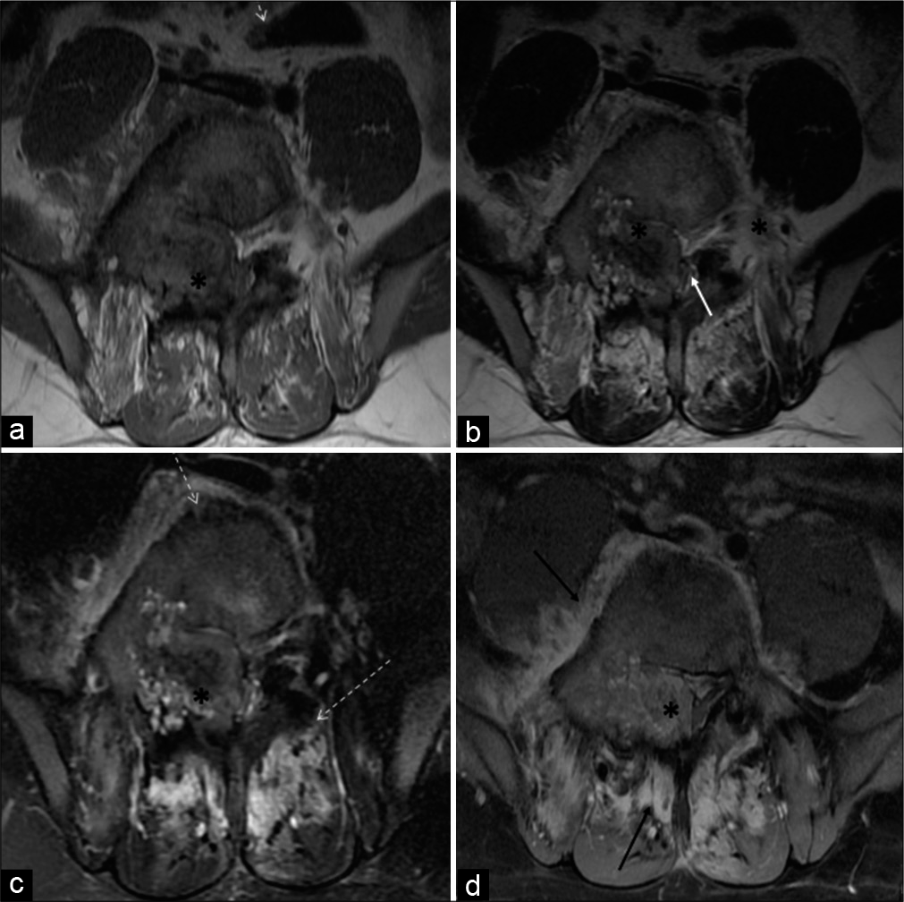 A 23-year-old male who was diagnosed with osteoblastoma showing toxic flare and coexistent HLA-B27-related ankylosing spondylitis. Axial T1-W (a) and axial T2-W (b) MR images reveal heterogeneous mixed signal intensity expansile lesion (asterisk) centered in the right neural arch of the L5 vertebral body involving right pedicle, transverse process, and part of the lamina. It is extending into the spinal canal and causing compression/displacement of thecal sac (white arrow). Axial T2-W fat-suppressed (c) and axial T1-W fat-suppressed post-contrast MR images (d) reveal significant periostitis depicted along the vertebral body and contralateral posterior elements (dashed arrows). Heterogeneous and avid enhancement is seen in the lesion (asterisk) with enhancing pre, right paravertebral, posterior paraspinous soft tissues (black arrow).