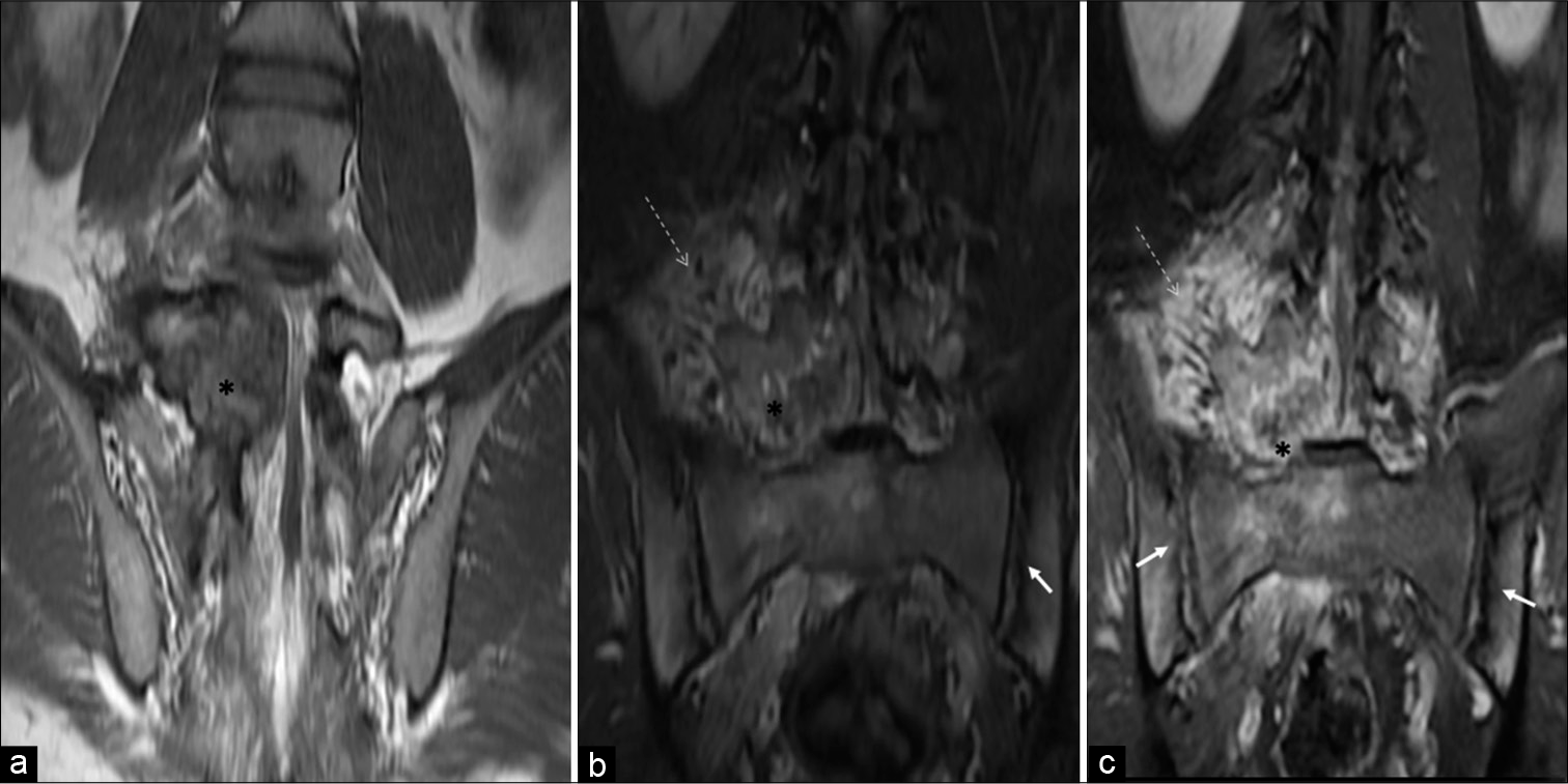 A 23-year-old male who was diagnosed with osteoblastoma showing toxic flare and coexistent HLA-B27-related ankylosing spondylitis. Coronal T1-W (a), coronal short-tau inversion recovery (b), and coronal T1-W fat-suppressed post-contrast MR (c) images reveal osteoblastoma (asterisk) centered in the right neural arch of L5 vertebra showing heterogeneous enhancement with significant periostitis, STIR hyperintense, and enhancing right paravertebral/perilesional soft-tissue edema (dashed arrows) associated with coexisting bilateral symmetrical inflammatory acute sacroiliitis (arrows).