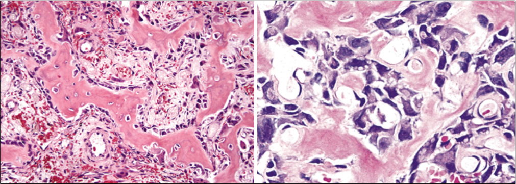 Histopathological examination showed anastomosing trabeculae of woven bone lined by a single layer of plump osteoblasts within a loosely textured fibrovascular stroma suggesting osteoblastoma.