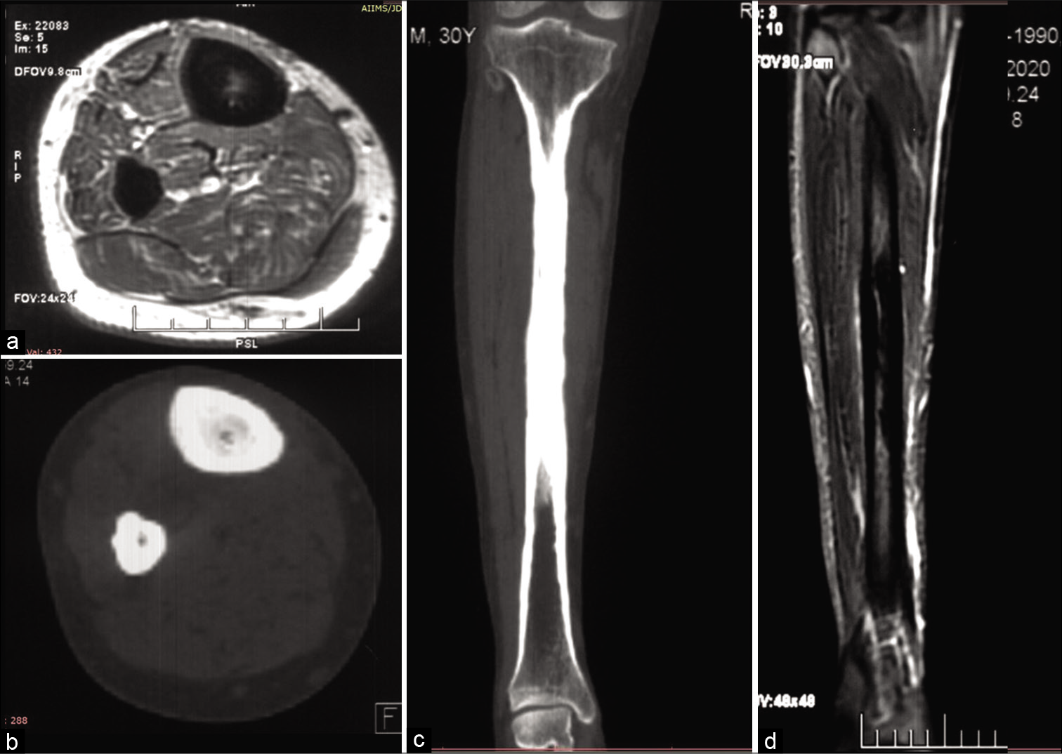 Magnetic resonance imaging (MRI) T1 weighted axial images of the right leg depict hypointense circumferential periosteal thickening with medullary narrowing (a) Corresponding axial computed tomography (CT) (b) and coronal CT (c) bone window confirmed the findings of the leg, MRI coronal short tau inversion recovery images (d) depict edema as hyperintensity along the midshaft of the tibia.