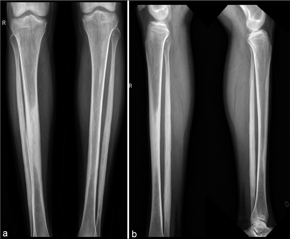 Frontal and lateral radiograph of both legs showing extensive periosteal reaction along the midshaft of right tibia, bilateral fibular shafts with sparing of distal ends. Note was made of early periosteal reaction along the left tibial midshaft.