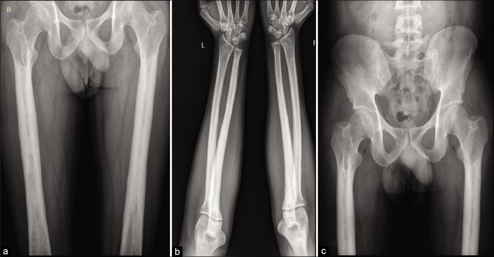 Frontal radiograph of both femori (a), bilateral elbow with forearm anterior-posterior (AP) radiograph (b), and pelvis AP radiograph (c) shows circumferential periosteal thickening with medullary narrowing along the proximal and midshaft of bilateral femori and proximal and midshaft radius and ulna.