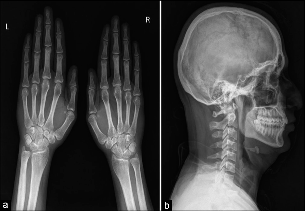 Frontal radiograph of both wrist with hands (a) and skull lateral radiograph (b) shows circumferential periosteal thickening with medullary narrowing along bilateral second metacarpal and bilateral 3rd proximal phalanges.